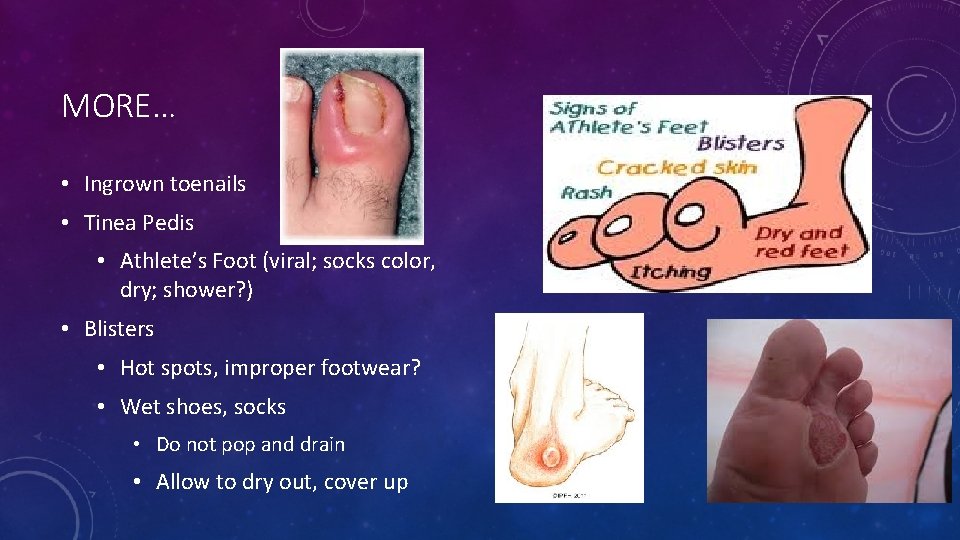 MORE… • Ingrown toenails • Tinea Pedis • Athlete’s Foot (viral; socks color, dry;