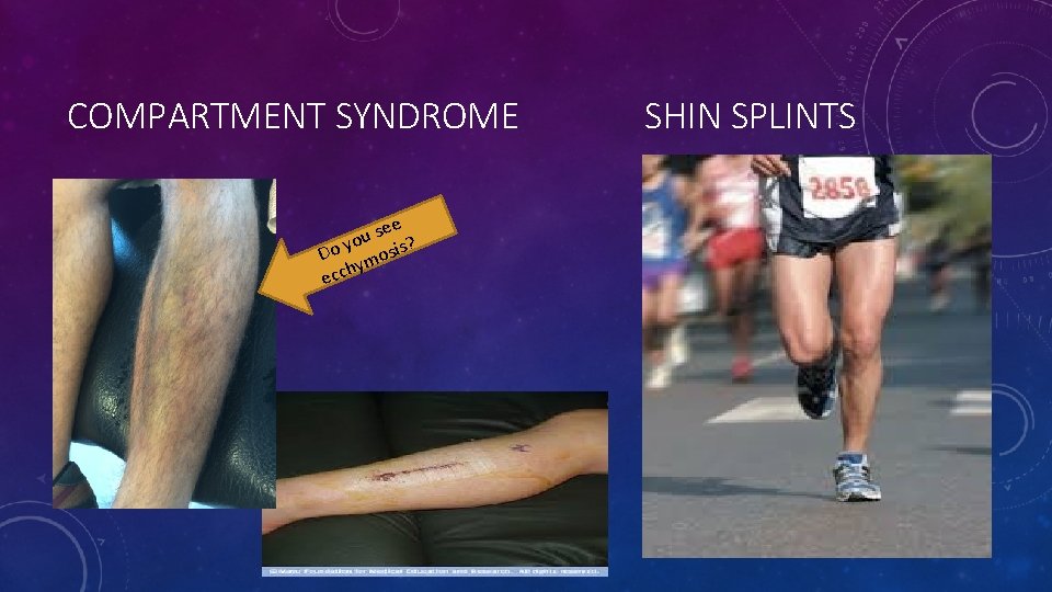 COMPARTMENT SYNDROME ee s u ? yo Do mosis hy c c e SHIN