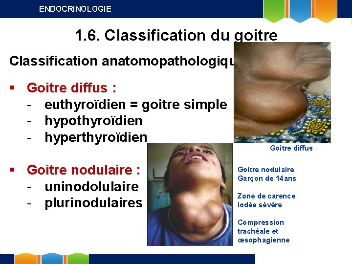 ENDOCRINOLOGIE 1. 6. Classification du goitre Classification anatomopathologique § Goitre diffus : - euthyroïdien