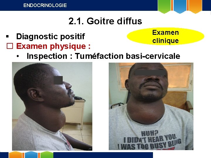 ENDOCRINOLOGIE 2. 1. Goitre diffus Examen clinique § Diagnostic positif � Examen physique :