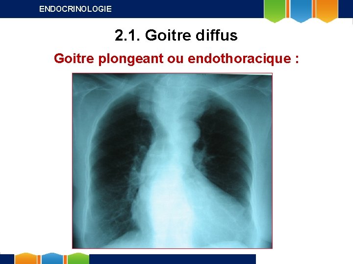 ENDOCRINOLOGIE 2. 1. Goitre diffus Goitre plongeant ou endothoracique : 