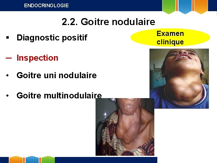 ENDOCRINOLOGIE 2. 2. Goitre nodulaire § Diagnostic positif ─ Inspection • Goitre uni nodulaire