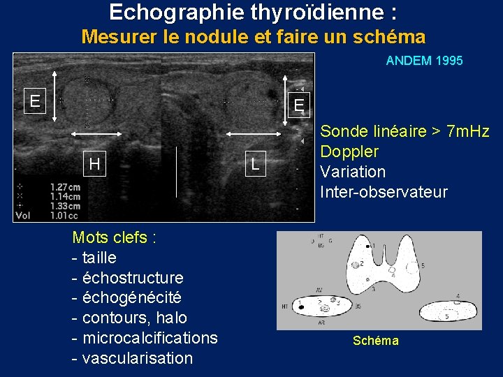 Echographie thyroïdienne : Mesurer le nodule et faire un schéma ANDEM 1995 E E