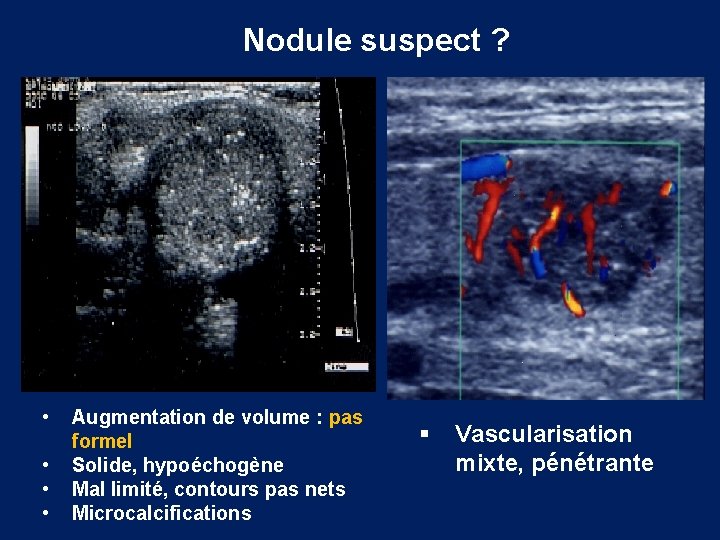 Nodule suspect ? • • Augmentation de volume : pas formel Solide, hypoéchogène Mal