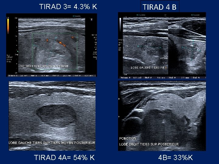 TIRAD 3= 4. 3% K TIRAD 4 A= 54% K TIRAD 4 B 4