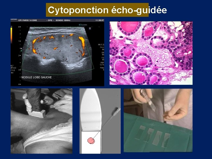 Cytoponction écho-guidée 