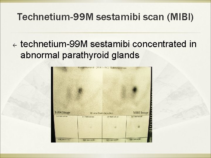 Technetium-99 M sestamibi scan (MIBI) ß technetium-99 M sestamibi concentrated in abnormal parathyroid glands