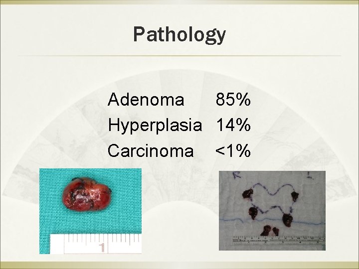 Pathology Adenoma 85% Hyperplasia 14% Carcinoma <1% 