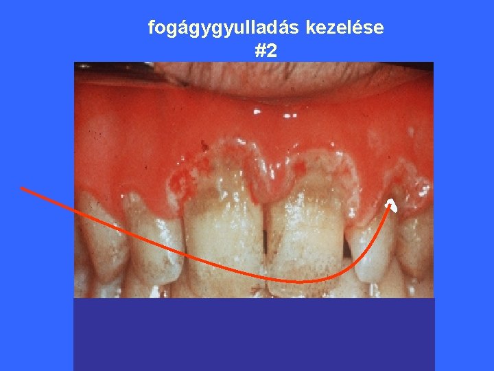 fogágygyulladás kezelése #2 iny alatti régió besugárzása 