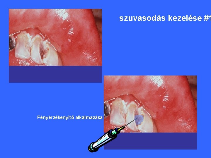 szuvasodás kezelése #1 Fényérzékenyìtő alkalmazása 