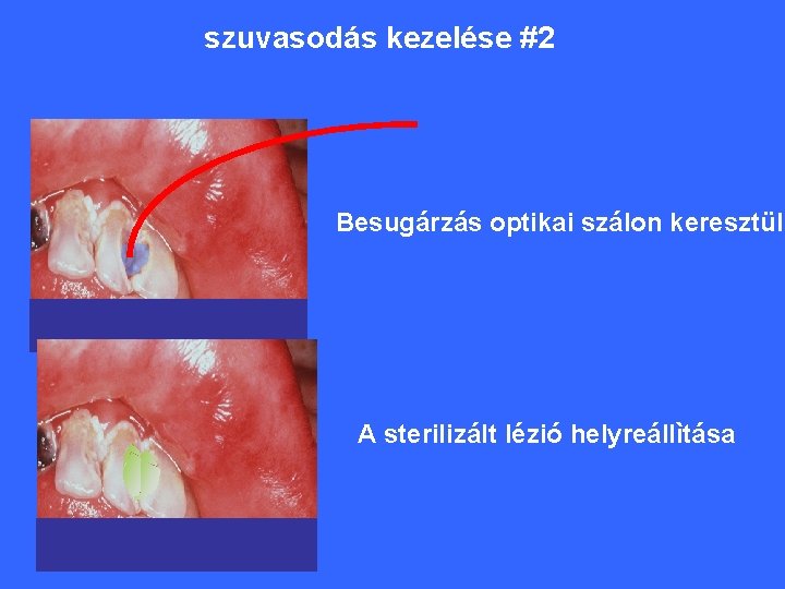 szuvasodás kezelése #2 Besugárzás optikai szálon keresztül A sterilizált lézió helyreállìtása 