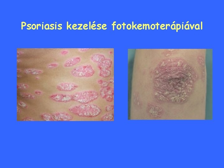 Psoriasis kezelése fotokemoterápiával 