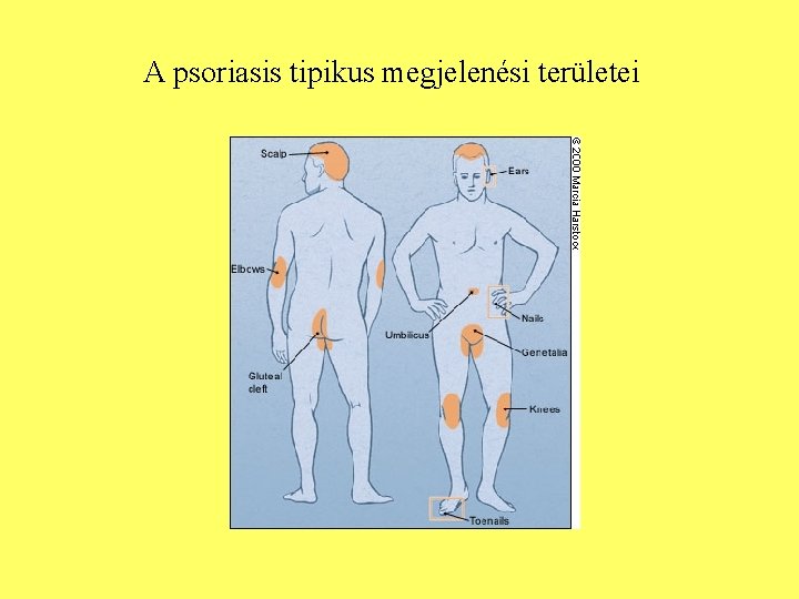 A psoriasis tipikus megjelenési területei 