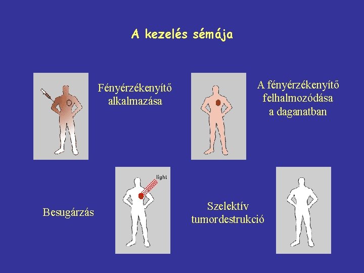 A kezelés sémája Fényérzékenyítő alkalmazása Besugárzás A fényérzékenyítő felhalmozódása a daganatban Szelektív tumordestrukció 