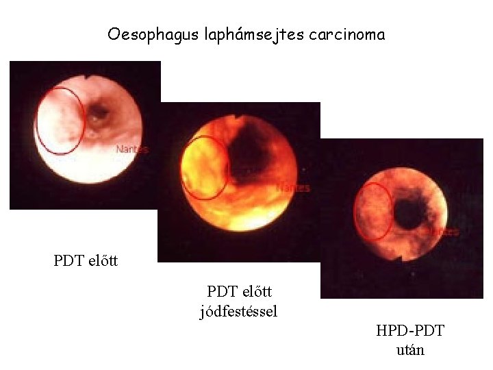 Oesophagus laphámsejtes carcinoma PDT előtt jódfestéssel HPD-PDT után 