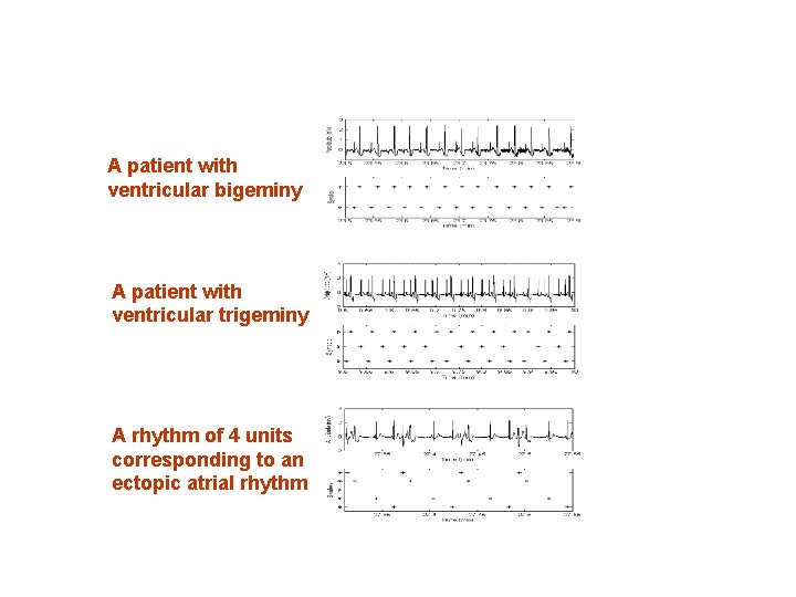 A patient with ventricular bigeminy A patient with ventricular trigeminy A rhythm of 4