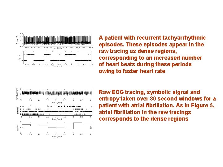 A patient with recurrent tachyarrhythmic episodes. These episodes appear in the raw tracing as