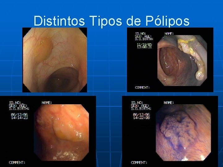 Distintos Tipos de Pólipos 