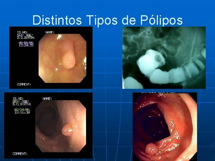 Distintos Tipos de Pólipos 