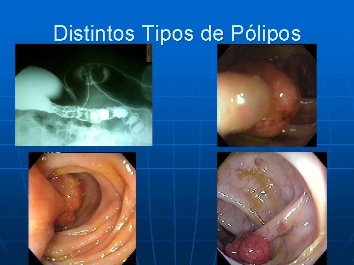 Distintos Tipos de Pólipos 