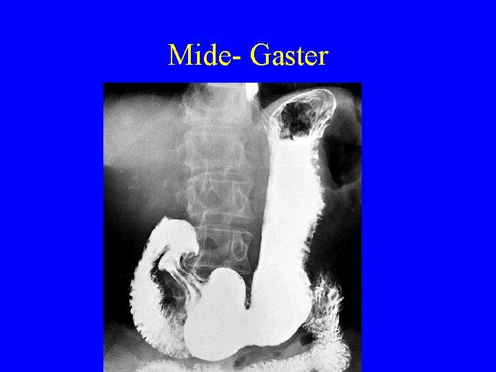 Mide- Gaster 