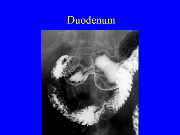 Duodenum 