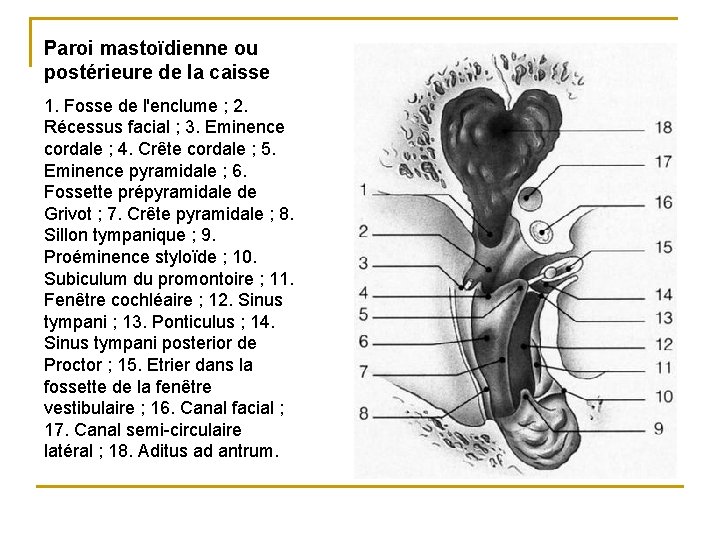 Paroi mastoïdienne ou postérieure de la caisse 1. Fosse de l'enclume ; 2. Récessus