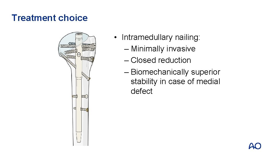 Treatment choice • Intramedullary nailing: – Minimally invasive – Closed reduction – Biomechanically superior