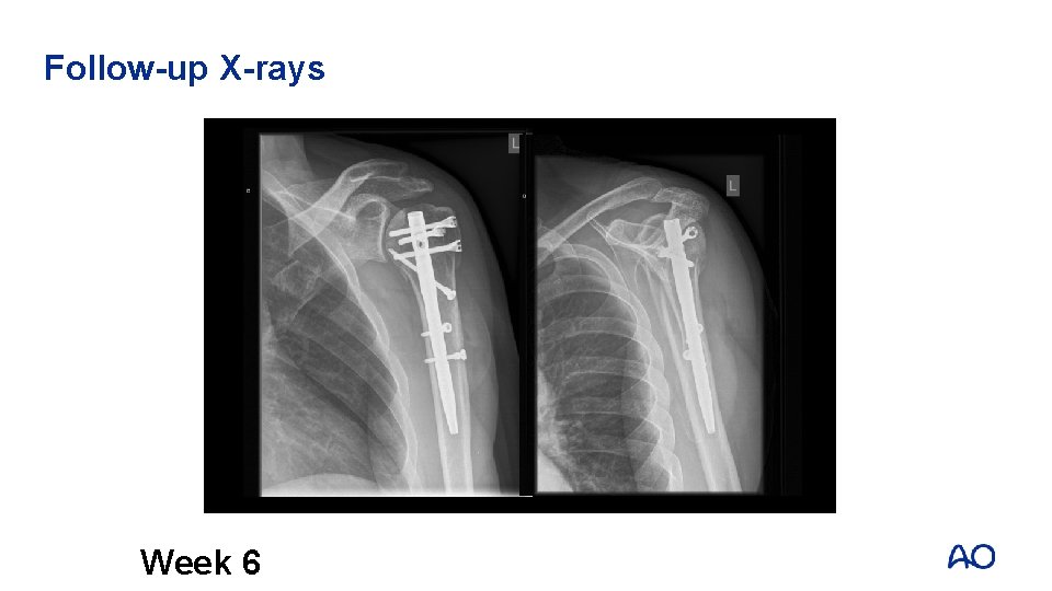 Follow-up X-rays Week 6 