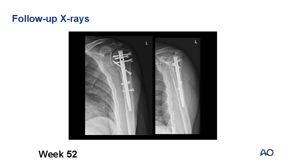 Follow-up X-rays Week 52 