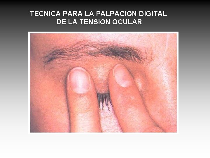 TECNICA PARA LA PALPACION DIGITAL DE LA TENSION OCULAR 