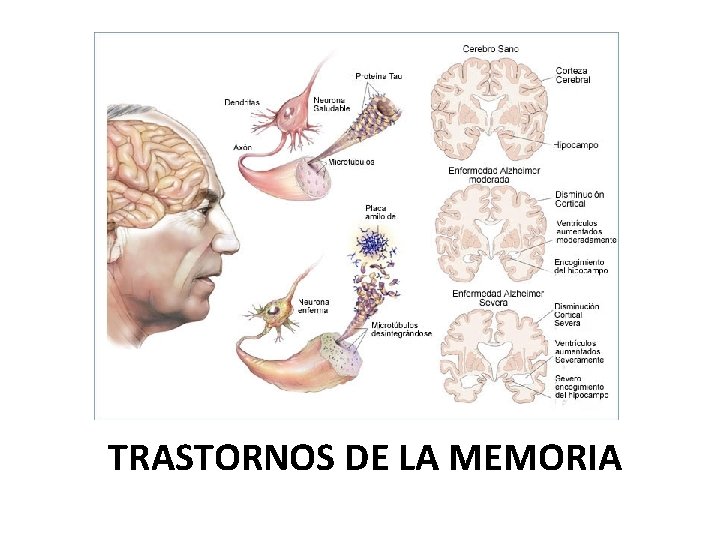 TRASTORNOS DE LA MEMORIA 