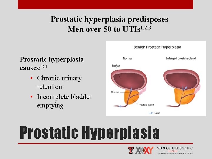 Prostatic hyperplasia predisposes Men over 50 to UTIs 1, 2, 3 Prostatic hyperplasia causes: