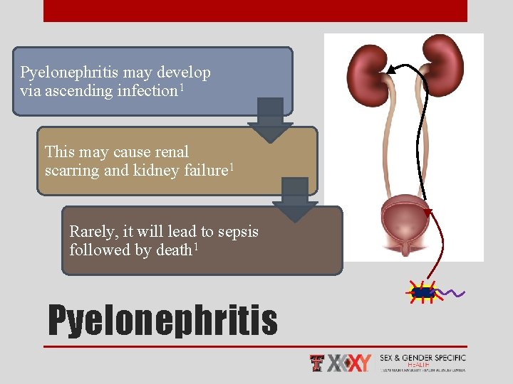 Pyelonephritis may develop via ascending infection 1 This may cause renal scarring and kidney