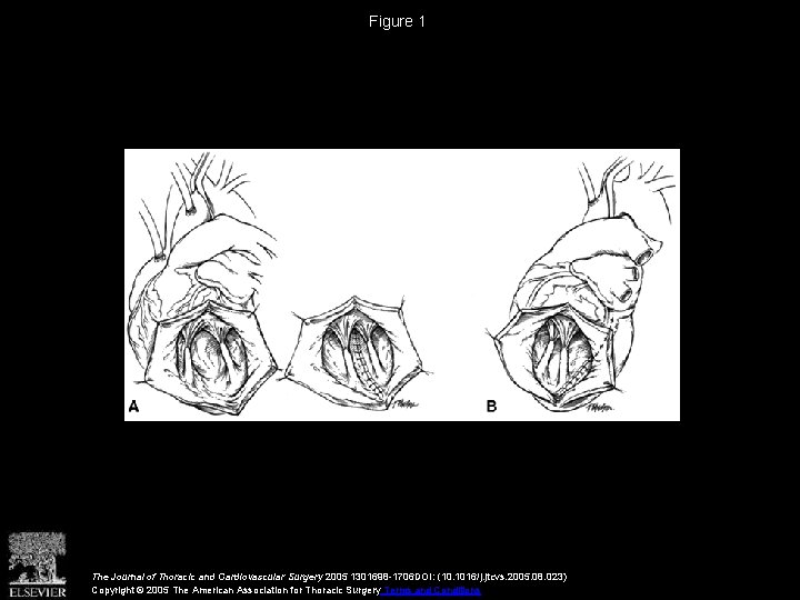 Figure 1 The Journal of Thoracic and Cardiovascular Surgery 2005 1301698 -1706 DOI: (10.