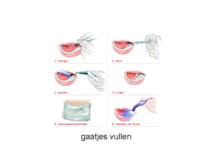 gaatjes vullen 