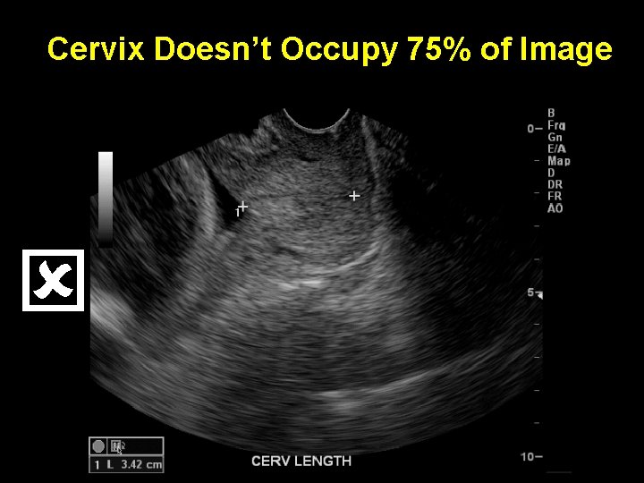 Cervix Doesn’t Occupy 75% of Image 