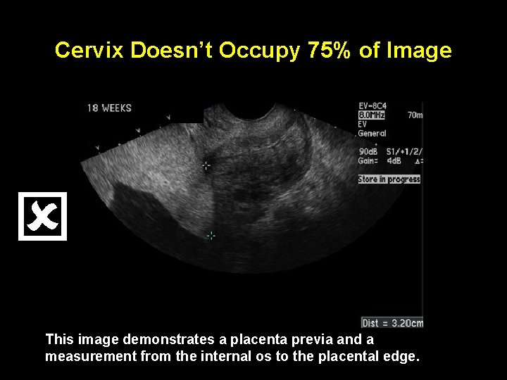 Cervix Doesn’t Occupy 75% of Image This image demonstrates a placenta previa and a
