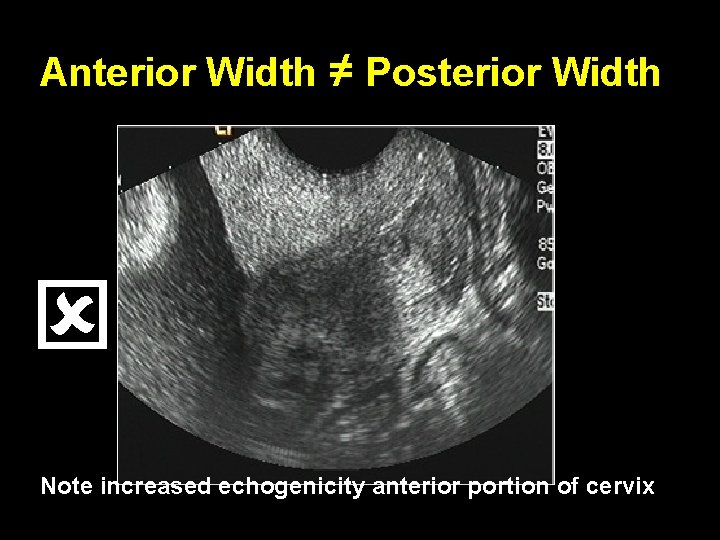 Anterior Width ≠ Posterior Width Note increased echogenicity anterior portion of cervix 