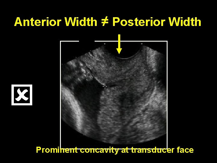 Anterior Width ≠ Posterior Width Prominent concavity at transducer face 