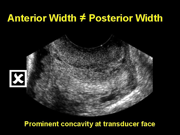 Anterior Width ≠ Posterior Width Prominent concavity at transducer face 