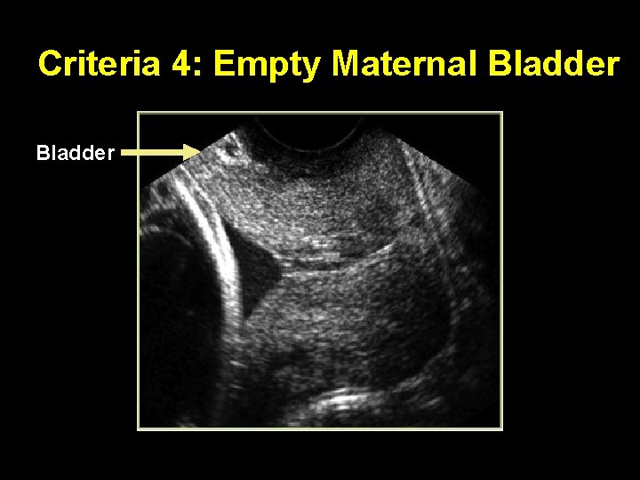 Criteria 4: Empty Maternal Bladder 