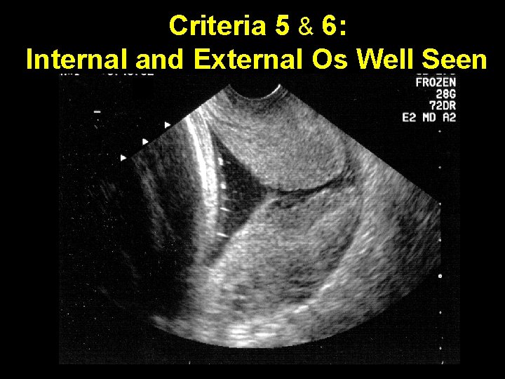 Criteria 5 & 6: Internal and External Os Well Seen 