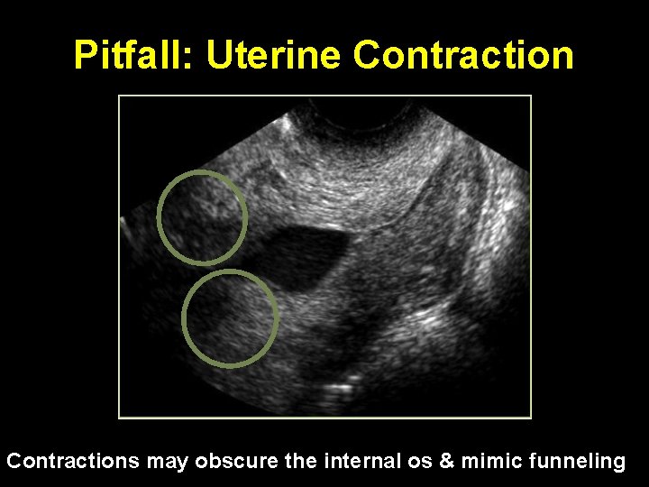 Pitfall: Uterine Contractions may obscure the internal os & mimic funneling 