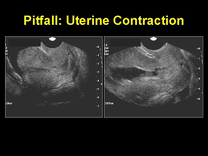 Pitfall: Uterine Contraction 
