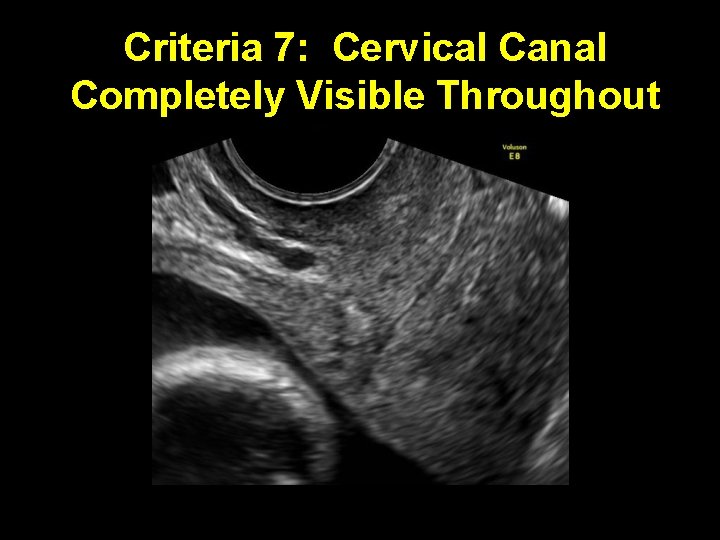 Criteria 7: Cervical Canal Completely Visible Throughout 