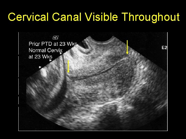 Cervical Canal Visible Throughout This is an example of an exception to the bladder
