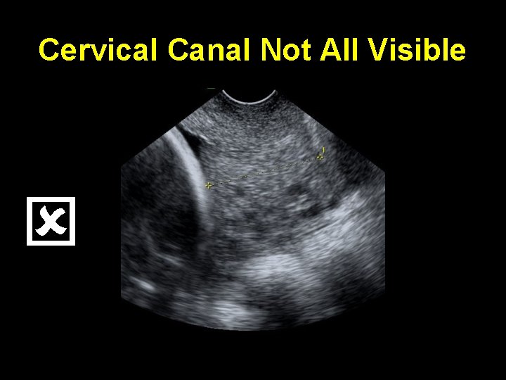 Cervical Canal Not All Visible 