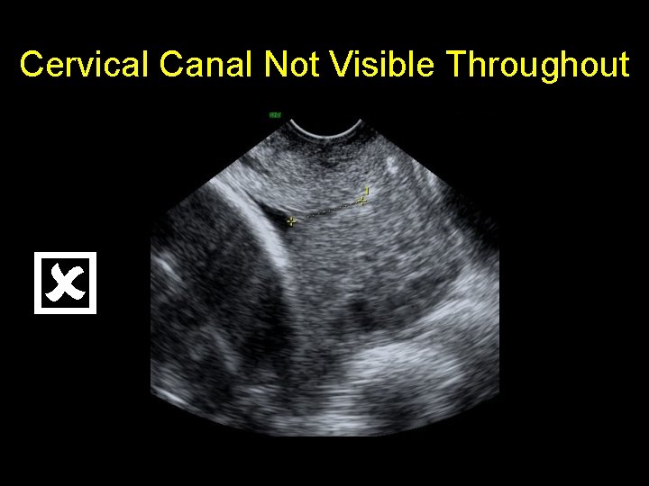 Cervical Canal Not Visible Throughout 