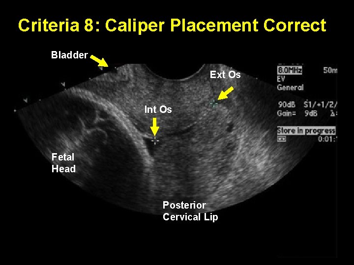Criteria 8: Caliper Placement Correct Bladder Ext Os Int Os Fetal Head Posterior Cervical